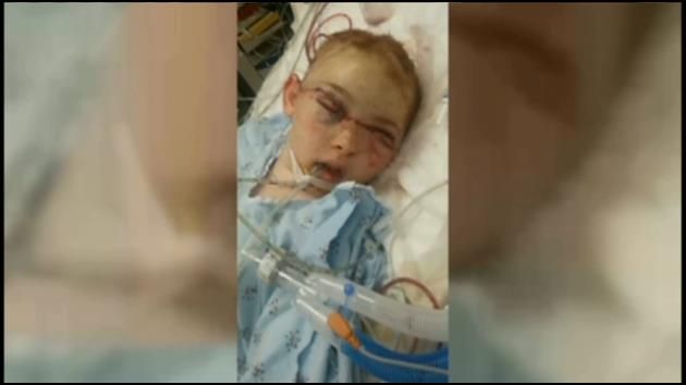 Girl hurt on carnival ride has surgery to repair scalp