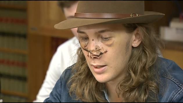 Man hurt by road debris speaks out about injuries