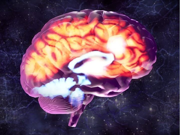 87 of 91 ex-NFL players had brain disease linked to concussions and head trauma